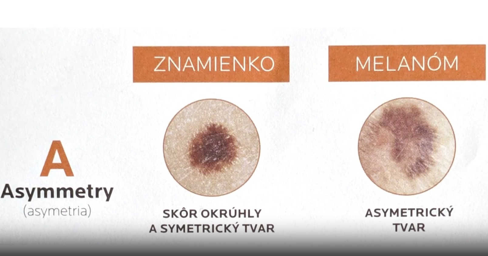 Tvar melanómu